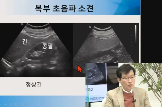 [서울백병원 LIVE]
‘지방간의 위험성과 치료’